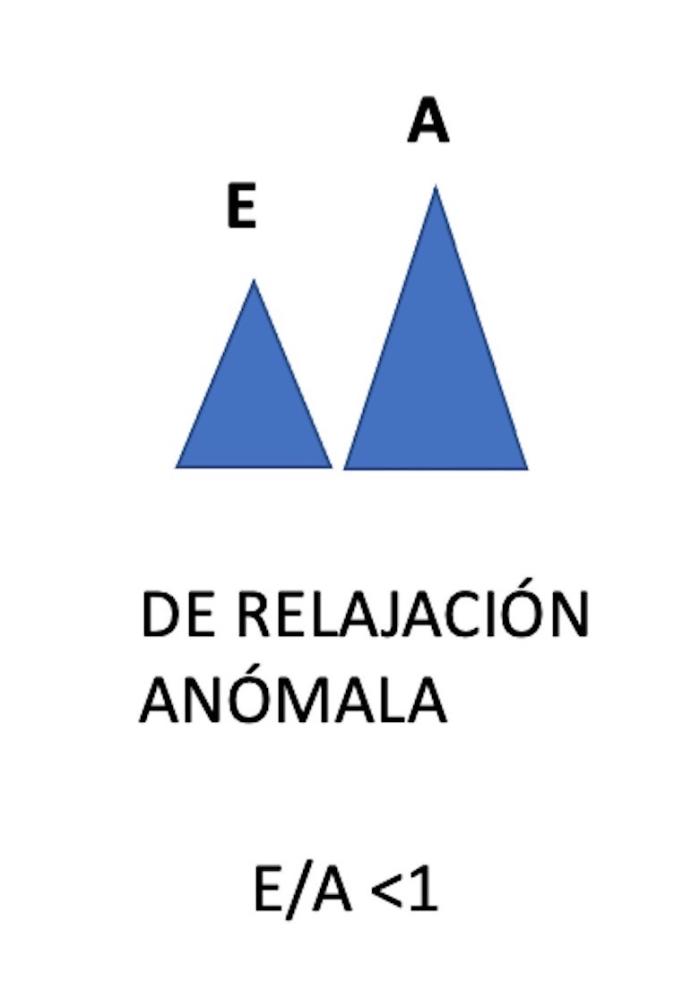 Figura 5. (A) Patrón transmitral de relajación anómala, onda E inferior a onda A, con ratio E/A<1. (B) Patrón transmitral en un gato geriátrico de 18 años.