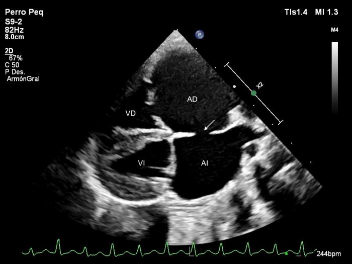 Figura 2. Ecocardiograma 2D, obtenido mediante acceso paraesternal derecho de eje largo, 4 cámaras donde se observa dilatación importante de los dos atrios, un defecto del septo atrial tipo ostium secundum (flecha) y leve prolapso de la válvula mitral. AD, atrio derecho; AI, atrio izquierdo; VD, ventrículo derecho; VI, ventrículo izquierdo.