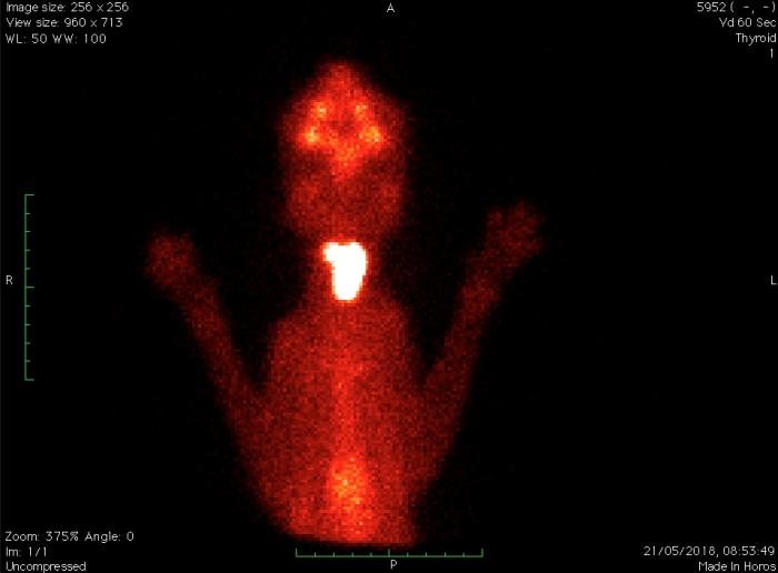 Figura 5. Gammagrafía tiroidea de la paciente en proyección ventral. En la que observamos un patrón bilateral asimétrico (ambos lóbulos afectados), detectamos mayor actividad y volumen en el lado izquierdo (derecha de la imagen).