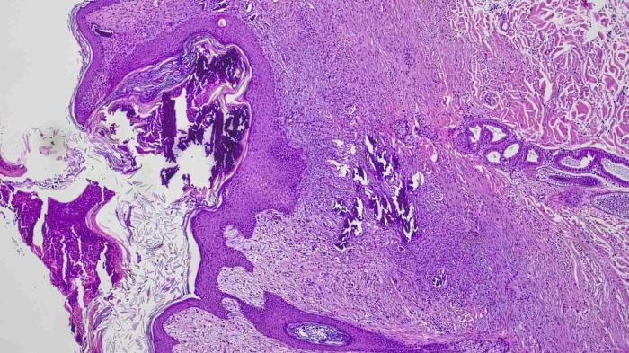 Figura 9. Imagen del corte histológico de las lesiones donde se observa el depósito de sales (restos violetas oscuros en la zona apical de la imagen y zona de la dermis) con infiltrado celular en la zona de la dermis.