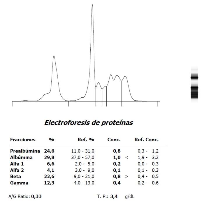 Figura 8. (A) Hipoalbuminemia e hiperbetaglobulinemia en un Amazona leucocephala con PCR en heces positiva a Mycobacterium simiae complex y (B) evolución tras tratamiento.