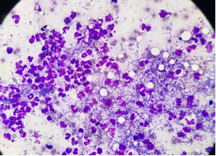 Figura 2. Infiltrado neutrofílico con abundantes bacterias cocobacilares intra y extracitoplasmáticas.