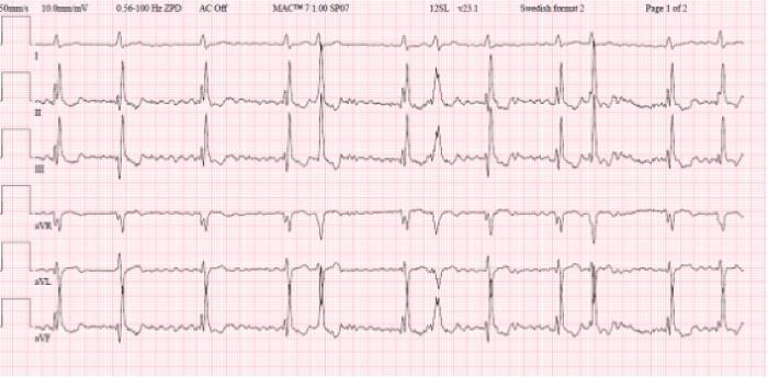 Figura 2. Trazado electrocardiográfico del paciente, en el que se aprecian las alteraciones electrocardiográficas descritas.