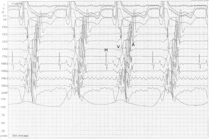 Figura 3. Electrocardiograma endocavitario durante el estudio electrofisiológico y ablación de una vía accesoria posterior-lateral. (H) Haz de His, (V) ventrículo, (A) atrio (imagen cedida por el Dr. Roberto Santilli).