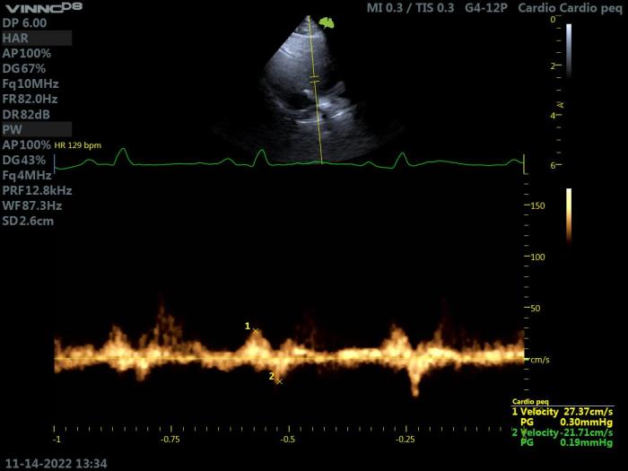 Figura 15. Ecocardiografía Doppler en un gato con HCM. Proyección paraesternal izquierda apical 4 cámaras, corte oblicuo. Valoración de las velocidades de la sangre en el apéndice auricular izquierdo, obteniendo valores > 20 cm/s, que indican un menor riesgo trombótico.