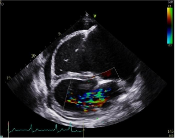 Figura 4. (A) Examen con Doppler Color de la válvula mitral en un corte paraesternal derecho de cuatro cámaras en el que se aprecia la regurgitación mitral. (B) Modo M a nivel de los ventrículos mediante eje corto por ventana paraesternal derecha.