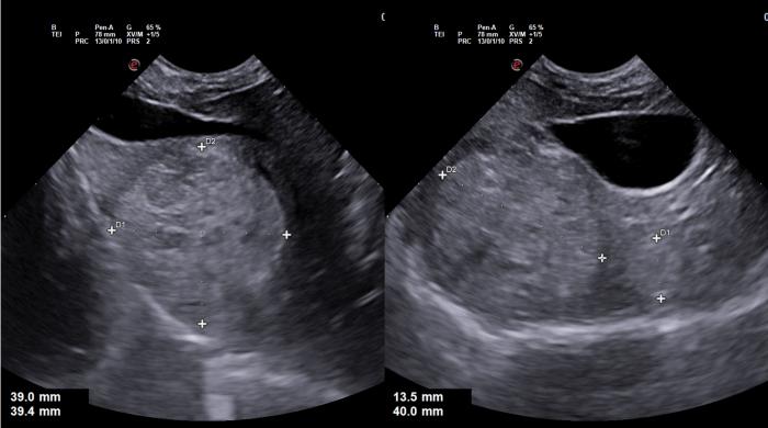 Figura 11. Ecografía abdominal que revela una masa hepática hiperecoica y heterogénea de 4 cm de diámetro en la región derecha del hígado. También se observa un nódulo similar, aunque más pequeño (1.5 cm), en una posición más medial.