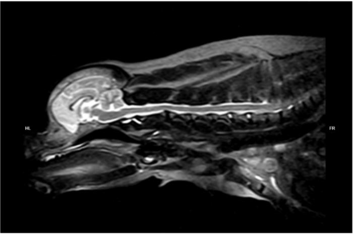 Figura 9. (A) Resonancia magnética: Hernia Hansen tipo II, C2/C3. Proceso inflamatorio a nivel medular, mielitis y siringomielia leve en el segmento cervical. C6/C7 (gentileza MV Ezequiel Marini). No se observaron alteraciones relacionadas a recurrencia local su patología oncológica.  Vista sagital stir. (B) Vista Axial T2.