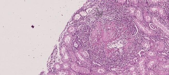 Figura 6. Riñón, córtex, ampliación. La flecha negra señala una vena rota invadida por el infiltrado inflamatorio y presencia de fibrina (flebitis).