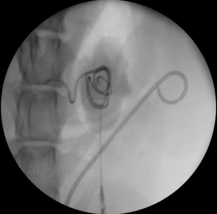 Figura 10. Migración proximal de catéter JJ en riñón derecho. Imagen de fluoroscopia, durante el acceso renal guiado por cirugía para su recolocación.