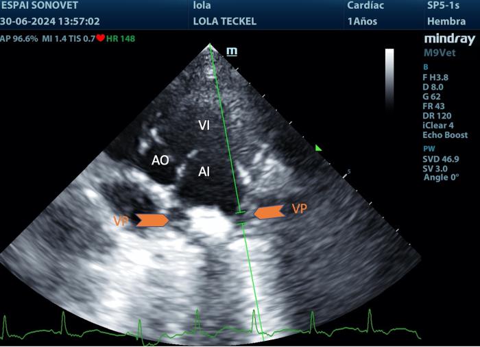 Figura 9. Situación del volumen de muestra del Doppler pulsado en vena pulmonar, en corte apical izquierdo 5 cámaras.