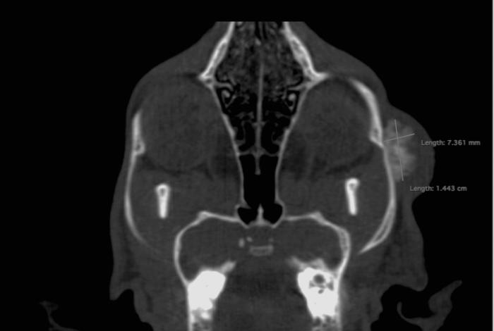 Figura 2. Vistas (A) longitudinal y (B) transversal, respectivamente del cráneo. Nótese la presencia de la masa calcificada, la cual no daña la cortical externa.