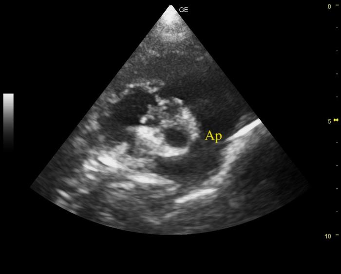 Figura 5. Corte paraesternal derecho eje corto del caso 2. Se observa dilatación de la arteria pulmonar (Ap).
