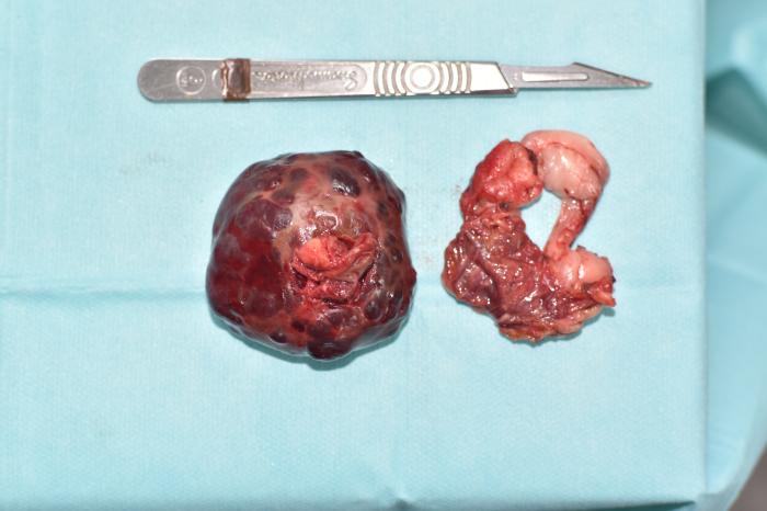 Figura 9. Imagen posoperatoria del pericardio y masa cardiaca extirpada con margen quirúrgico macroscópico.