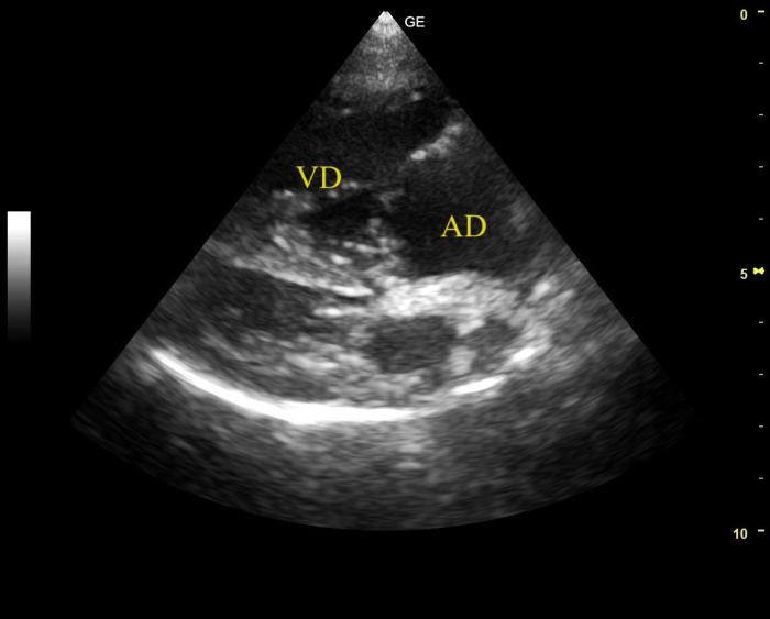 Figura 4. Corte paraesternal derecho  eje largo 4 cámaras del caso 2. Se observa dilatación del AD e hipertrofia concéntrica y excéntrica del VD.
