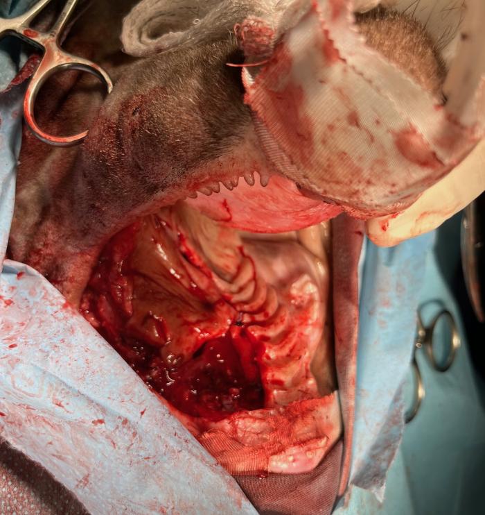 Figura 8. Imagen intraoperatoria. Una vez creado el colgajo labial basado en la arteria angular oral, se fijó por medial al mucoperiostio del paladar duro con puntos simples.