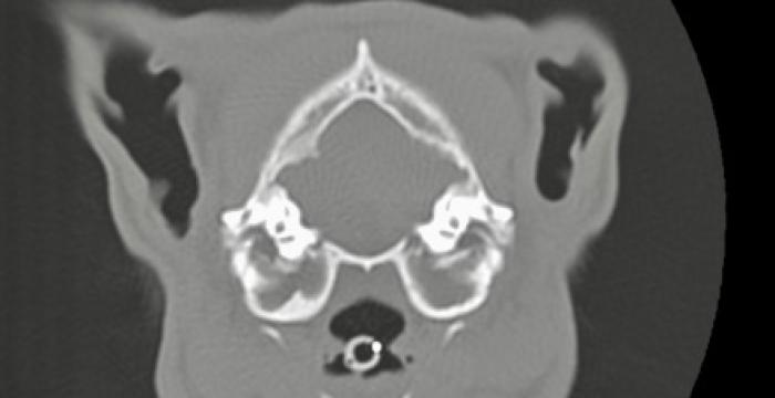 FIGURA 3A-B. Imagen del TAC. (A) Otitis media bilateral con posible formación de pólipos inflamatorios. (B) Otitis externa izquierda con severa estenosis del CAE.
