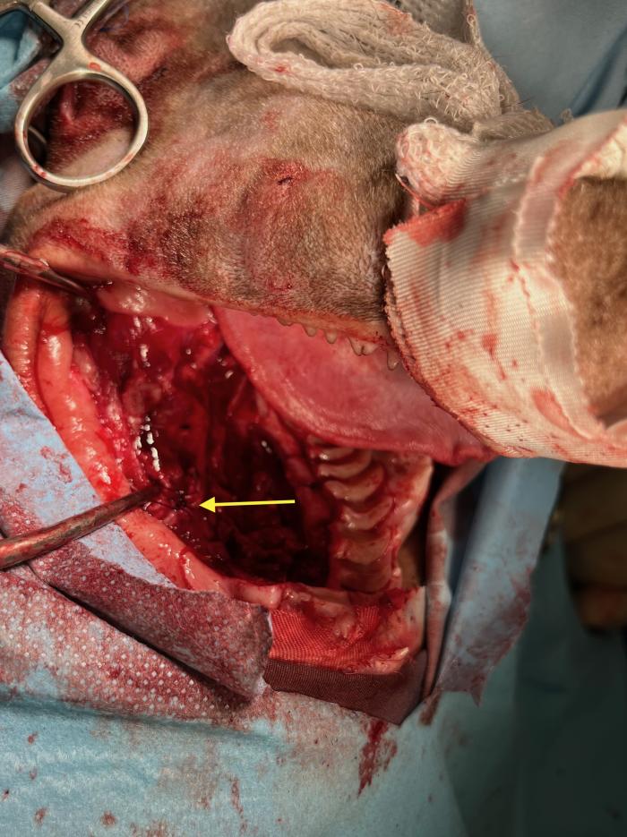 Figura 7. Imagen intraoperatoria mostrando el defecto tras la extirpación en bloque de la masa oral. La flecha amarilla indica la posición de la ligadura realizada tras identificar la rama infraorbitaria de la arteria maxilar.