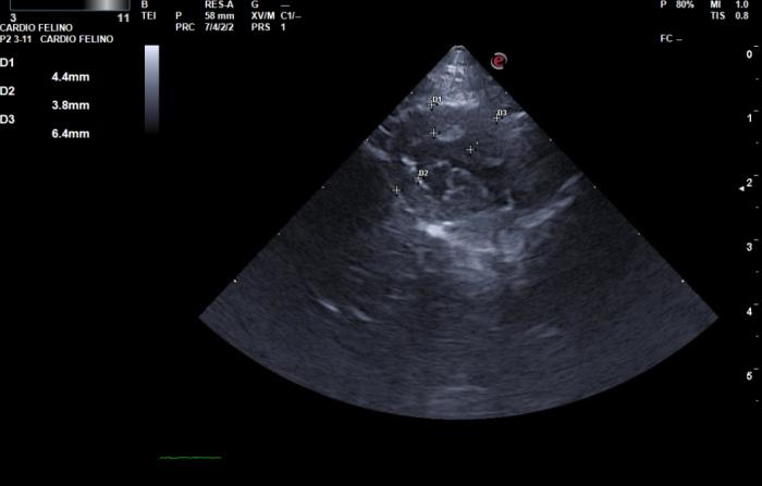 Figura 2. Ecocardiografía. (A) Hipertrofia ventrículo izquierdo. (B) Flujo aórtico turbulento. (C) Regurgitación mitral sin aumento AI. (D) Flujo aórtico turbulento.