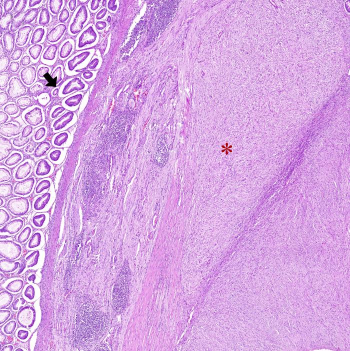Figura 2. Imágenes histológicas de la neoplasia. (A) Neoplasia originada en la túnica muscular (asterisco) expandiendo la submucosa y sin infiltrar mucosa (flecha). Hematoxilina-Eosina (H-E). (B) Neoplasia compuesta por células fusiformes dispuestas de forma entremezclada. H-E. (C) Las células presentaban una forma redonda-poligonal (células epitelioides). H-E. (D) Inmunomarcaje positivo para c-KIT. (E) Inmunomarcaje positivo para SMA. (F) Inmunomarcaje negativo para S100.