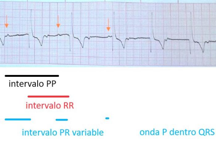 Figura 7. ECG en derivación II a 50 mm/s y 10 mm/mV. La onda P (flechas) presenta un intervalo PR variable, mostrándose cada vez más próxima al QRS hasta quedar incluida en él y ser por tanto no visible. Los intervalos PP (frecuencia atrial) y RR (frecuencia ventricular) son estables.