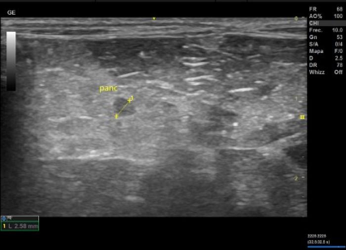 Figura 3. Nódulo pancreático de 2.58 mm de diámetro, compatible con insulinoma.