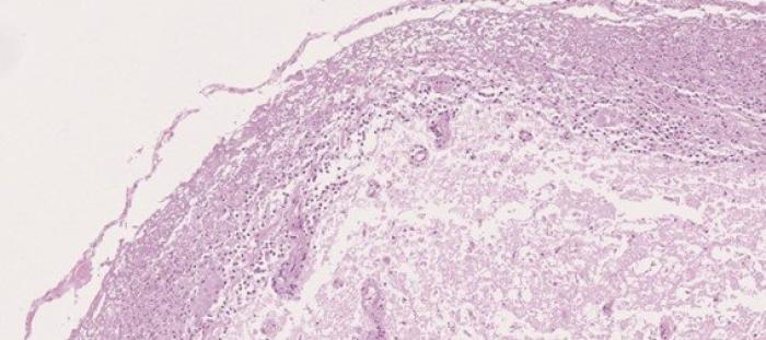 Figura 8. Médula espinal. Imagen ampliada del infiltrado inflamatorio en las leptomeninges.