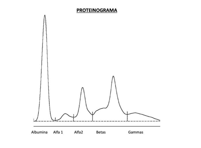 Figura 5. Proteinograma compatible con gammapatía monoclonal en región beta. Valores de betaglobulinas aumentados, en 2.3 g/dl (rango de referencia 0.9 - 1.6).