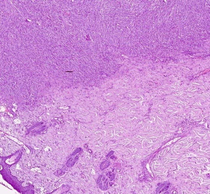 Figura 3. Imágenes histológicas del sarcoma asociado al punto de inyección. (A) Neoplasia expandiendo la dermis profunda y media. H-E. (B) La neoplasia está compuesta células fusiformes formando haces irregulares y parcialmente entrelazados. (C) Las células presentan leve anisocitosis y anisocariosis, pero abundantes figuras mitóticas (flechas). H-E. (D) En la segunda biopsia se observan numerosos neutrófilos, fibroblastos activados y vasos sanguíneos de nueva formación (tejido de granulación maduro) sin células neoplásicas. H-E.