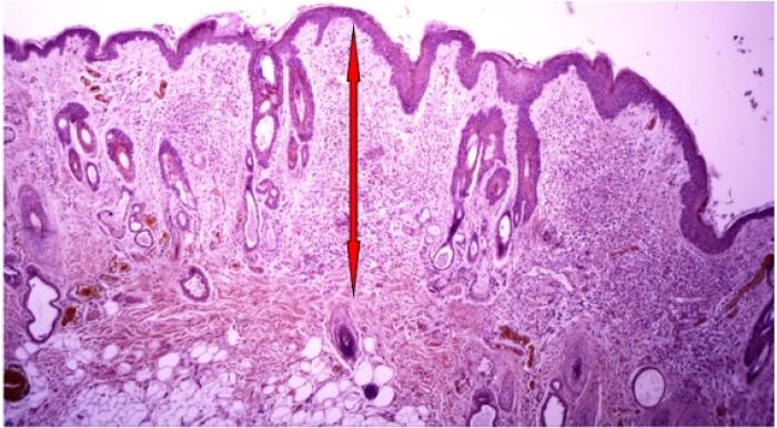 Figura 3. (A) Edema e infiltrado inflamatorio que ocupa toda la dermis. (B) Infiltrado formado por eosinófilos e histiocitos principalmente. (C) Eosinófilos señalados en el círculo.