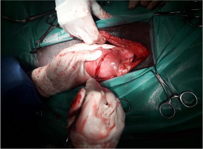 Figura 7. Imagen intraquirúrgica de incisión seromuscular de alrededor de 4 cm en el estómago, para posteriormente realizar la gastropexia.