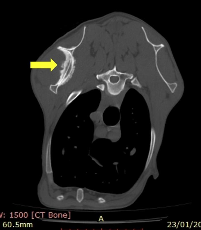 Figura 5. Imagen de tomografía computerizada poscontraste en plano axial donde se identifica una lesión osteoproliferativa en la escápula izquierda (flecha).