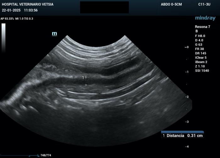 Figura 4A-B. Imágenes de ecografía abdominal sin signos de recidiva a los ocho meses tras el diagnóstico. 