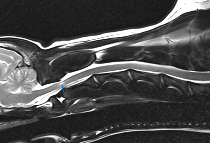 Figura 1. Vista sagital del área cervical del paciente mediante resonancia magnética. Obsérvese el incremento de señal (flecha) en la médula espinal en la zona correspondiente a C1-C2 debido a traumatismo e inflamación.
