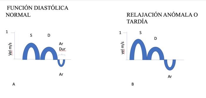 Figura 11. (A) Flujo vena pulomnar normal. (B) Patrón de flujo de vena pulmonar de relajación anómala.