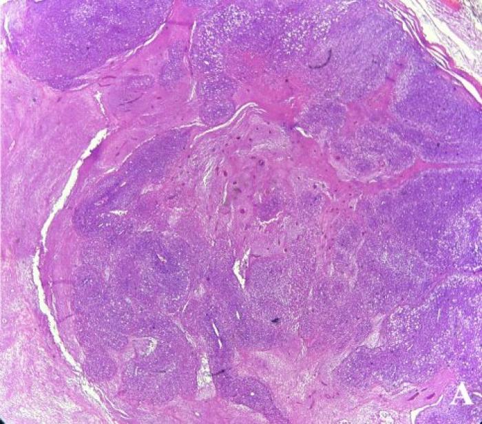 Figura 4. Imágenes histológicas del condrosarcoma. (A) Se observa una masa multinodular bien delimitada y no encapsulada. 5x, Hematoxilina-Eosina (H-E). (B) Proliferación de células mesenquimales redondeadas dispuestas de forma solida (condrocitos, flecha roja) y multifocales áreas de necrosis (flecha negra). 20x, H-E. (C) Moderada anisocitosis y leve anisocariosis de los condrocitos neoplásicos. 40x, H-E. (D) Los condrocitos neoplásicos se entremezclan con una matriz condroide que forma islotes de cartílago hialino (flecha negra). 40x, H-E.