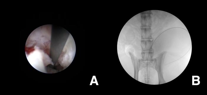 Figura 11. Monitorización (A) endoscópica y (B) fluoroscópica de la introducción de la guía hidrofílica durante las maniobras de sondaje uretral en paciente canino con CCT uretral.