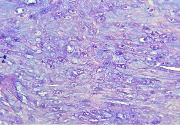 Imagen de corte histopatol&oacute;gico cedida por el doctor Federico Castro (pat&oacute;logo).