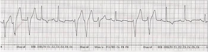 Figura 3. Electrocardiograma (ECG) con presentación de (A) complejos ventriculares prematuros, (B) taquicardia ventricular y (C) ritmo idioventricular acelerado (marcado en rojo).