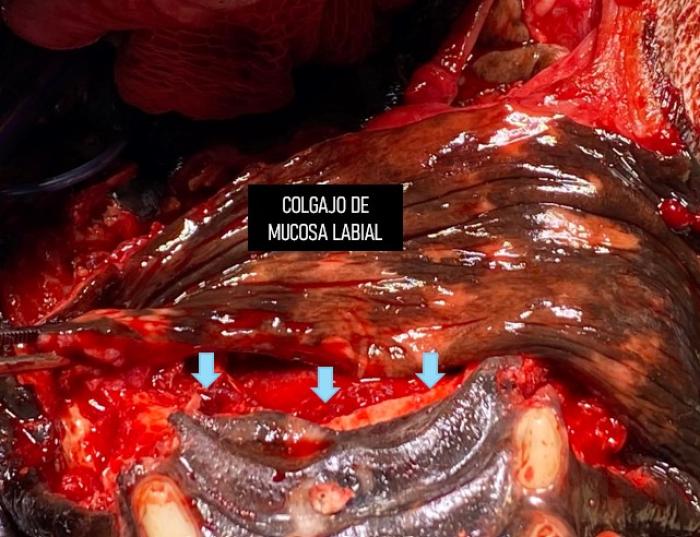 Figura 7. Colgajo liberado sin tensión posicionado sobre el defecto quirúrgico previo a la sutura con la mucosa palatina. Se señala con flechas el sitio de unión de la mucosa labial con la mucosa palatina sobre el escalón óseo previamente mencionado.