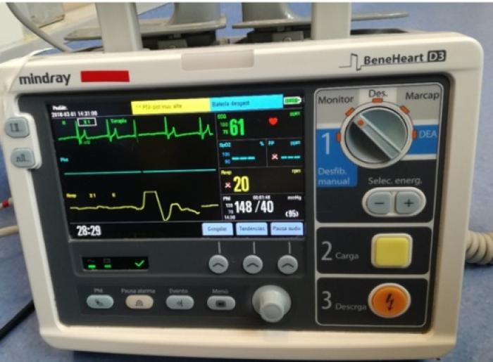 Figura 5. ECG de un paciente en crisis addisoniana. 
