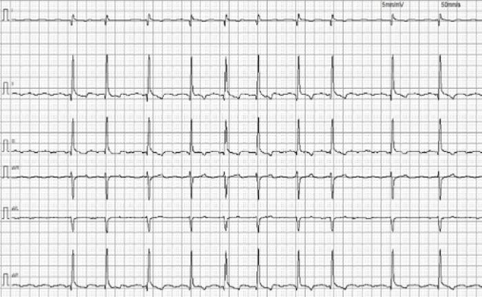 Figura 2A-B. ECG de superficie en el momento del episodio card&iacute;aco. A) ECG 6 derivaciones, 5 mm/mV y 50 mm/s. B) ECG en derivaci&oacute;n II, 5 mm/mV y 50 mm/s.