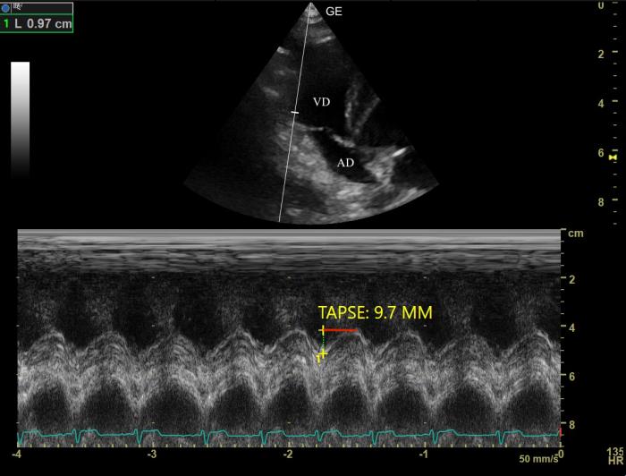 Figura 6. Imagen en modo M optimizada para anillo tricuspídeo y medición de TAPSE.