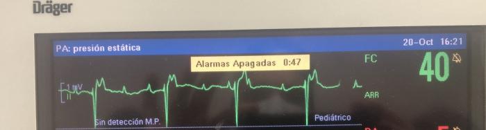 Figura 1. Imagen del EGC donde se puede apreciar el bloqueo atrioventricular de tercer grado antes de la colocación del marcapasos externo.