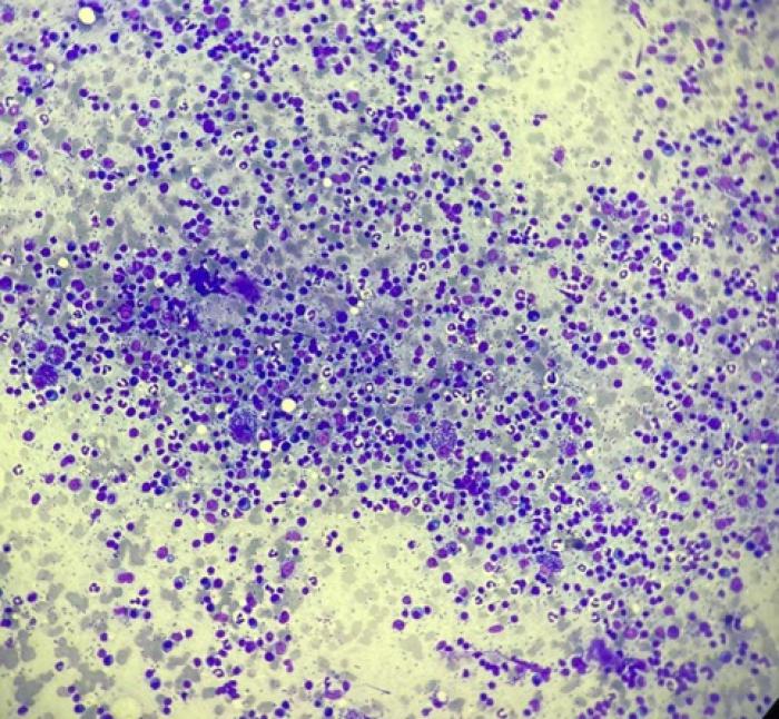 Figura 1. Leishmania en sangre periférica.