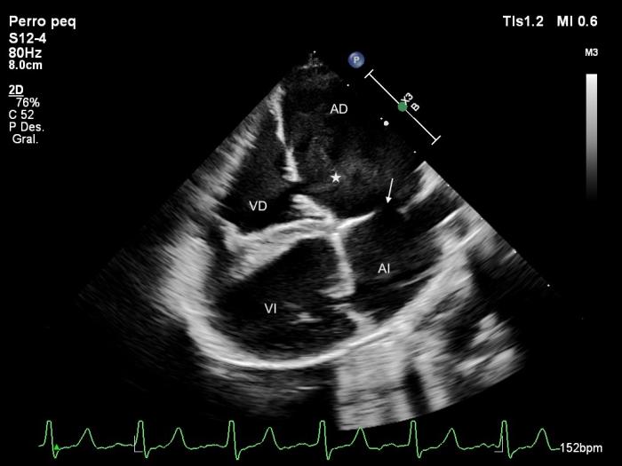 Figura 8. Ecocardiograma 2D, obtenido mediante acceso paraesternal derecho de eje largo, 4 cámaras donde se observa dilatación importante de los dos atrios, un defecto del septo atrial tipo ostium secundum (flecha), leve prolapso de la válvula mitral y contraste espontáneo en el AD (*).