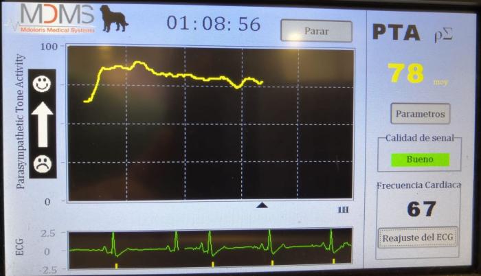 Figura 2. El monitor PTA o ANI permite monitorizar el índice de nocicepción de analgesia basándose en la variabilidad de la frecuencia cardiaca obtenida desde un ECG midiendo el tono parasimpático.