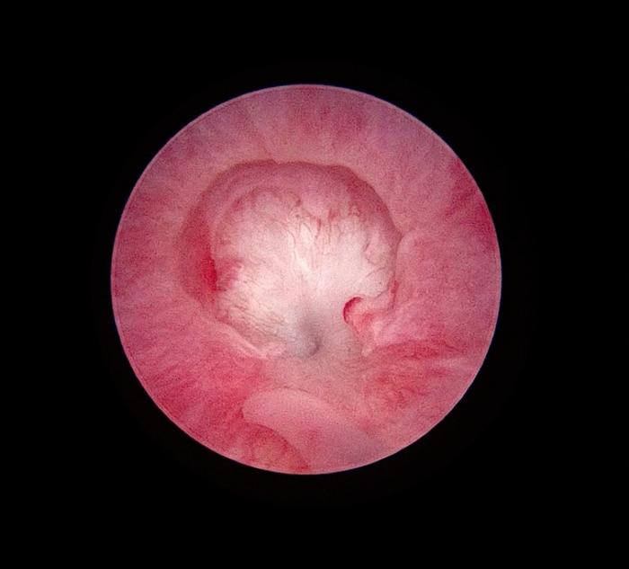 Figura 1. Estenosis uretral benigna en paciente canino secundaria a uretritis severa.