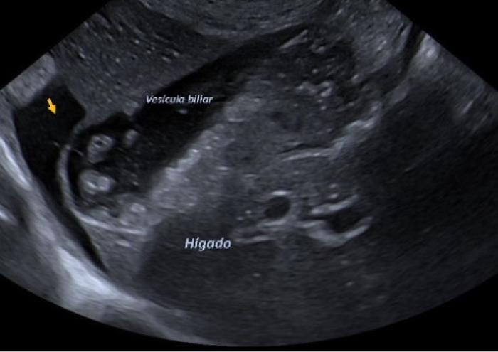 Figura 9. Imagen ecográfica abdominal donde puede visualizarse el parénquima hepático, la vesícula biliar (con concreciones biliares en su interior), y la presencia de líquido libre adyacente (flecha amarilla).