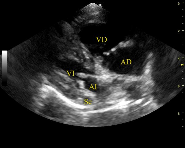 Figura 8. Corte paraesternal derecho eje largo 4 cámaras del caso 3. Se observa dilatación del AD, hipertrofia concéntrica y excéntrica del VD y marcada reducción del diámetro del atrio (AI) y ventrículo (VI) izquierdos, con dilatación del seno coronario (Sc).